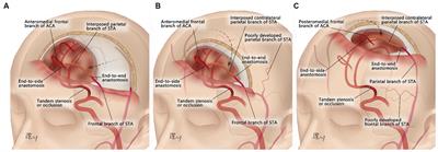 The interpositional bypass with a parietal branch of superficial temporal artery graft for symptomatic atherosclerotic anterior cerebral artery stenosis or occlusion